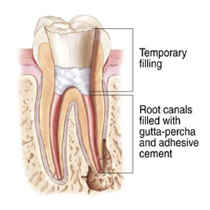 root tooth