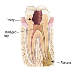 root canal